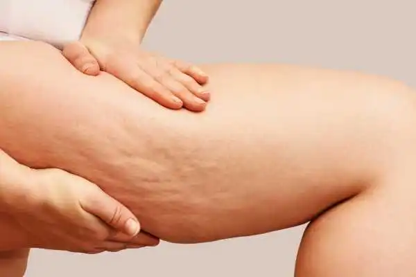 Image of woman showing leg with cellulite Drumbrae
