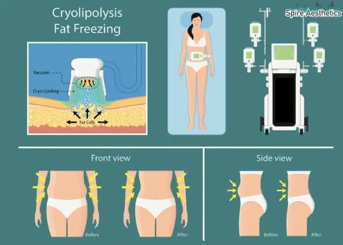 Fat freezing treatment Drumbrae benefits for competitions to remove stubborn fat deposits.