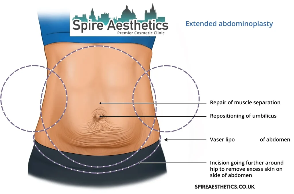Understanding Loose Skin After Gastric Band Drumbrae Surgery and HIFU Treatment